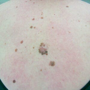 Other treatments - melanoma in the back