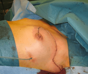 Breast conserving wide resection, in the operation