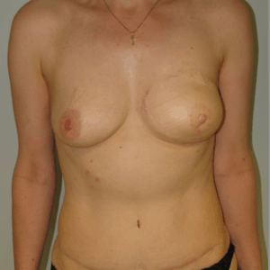 Breast reconstructions - neuro MS-TRAM, Sensing Breast