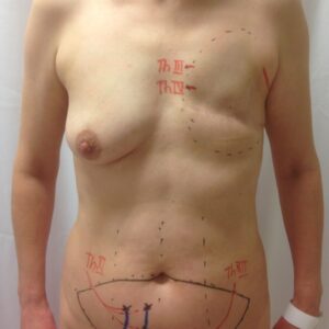 Breast reconstructions - neuro MS-TRAM, preop. plan