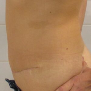 Aesthetic surgery - Abdominoplasty, side, after
